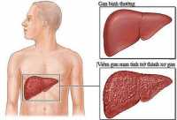 Thảo dược chữa bệnh ung thư gan